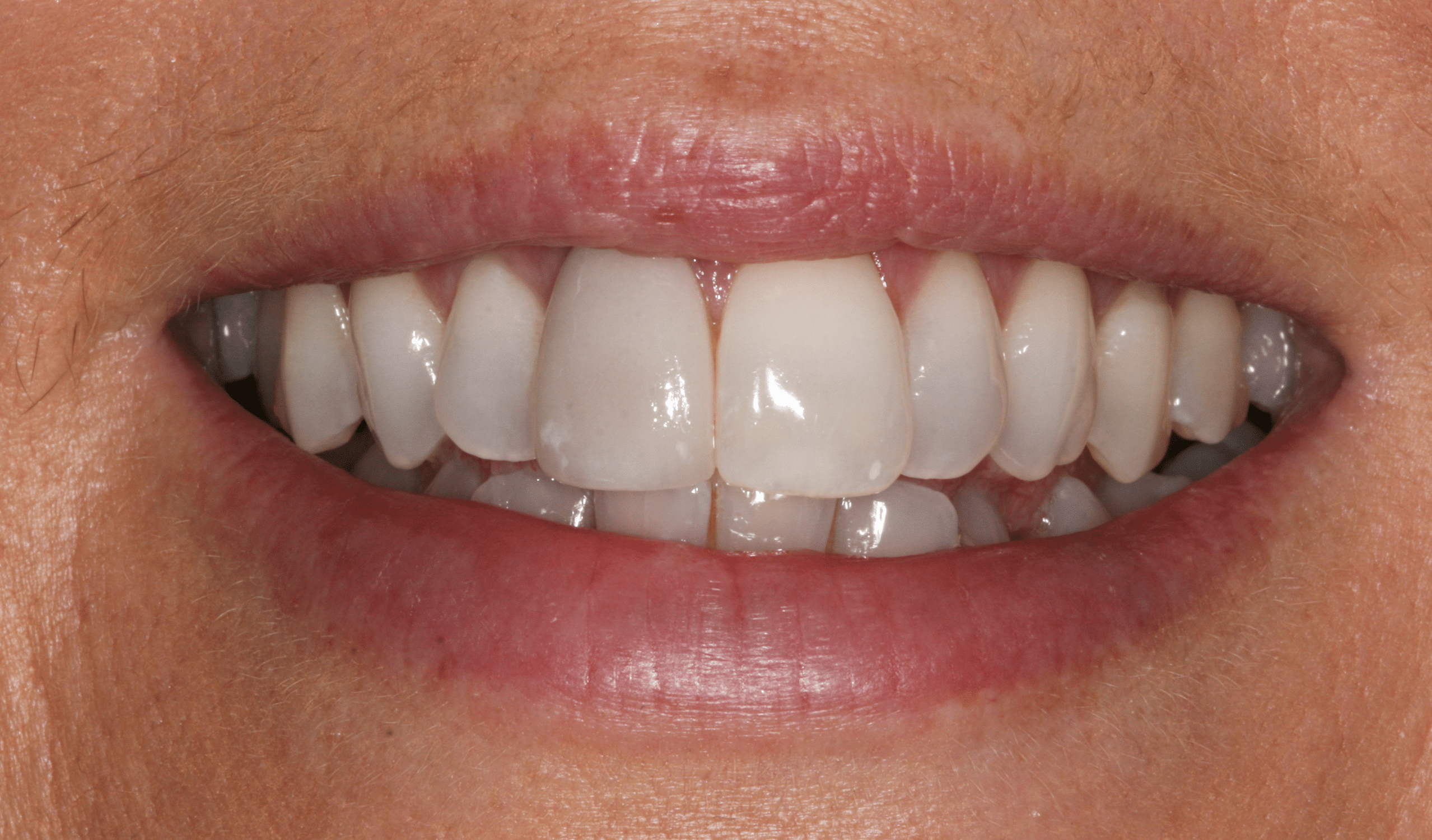 Crowns | Sandygate Dental