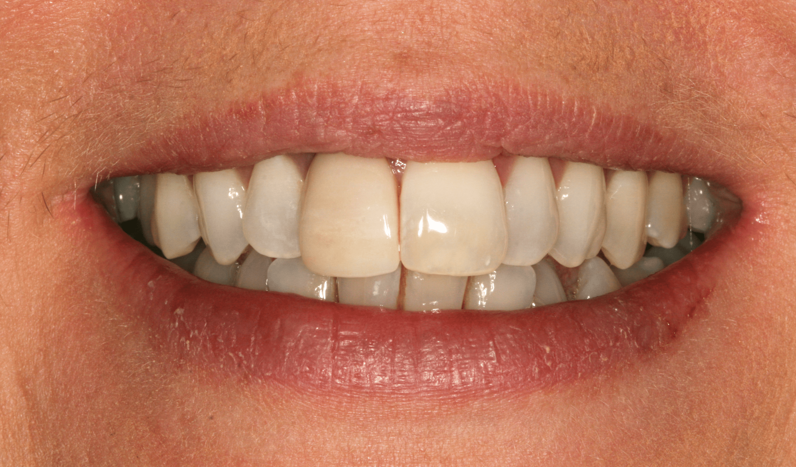Crowns | Sandygate Dental