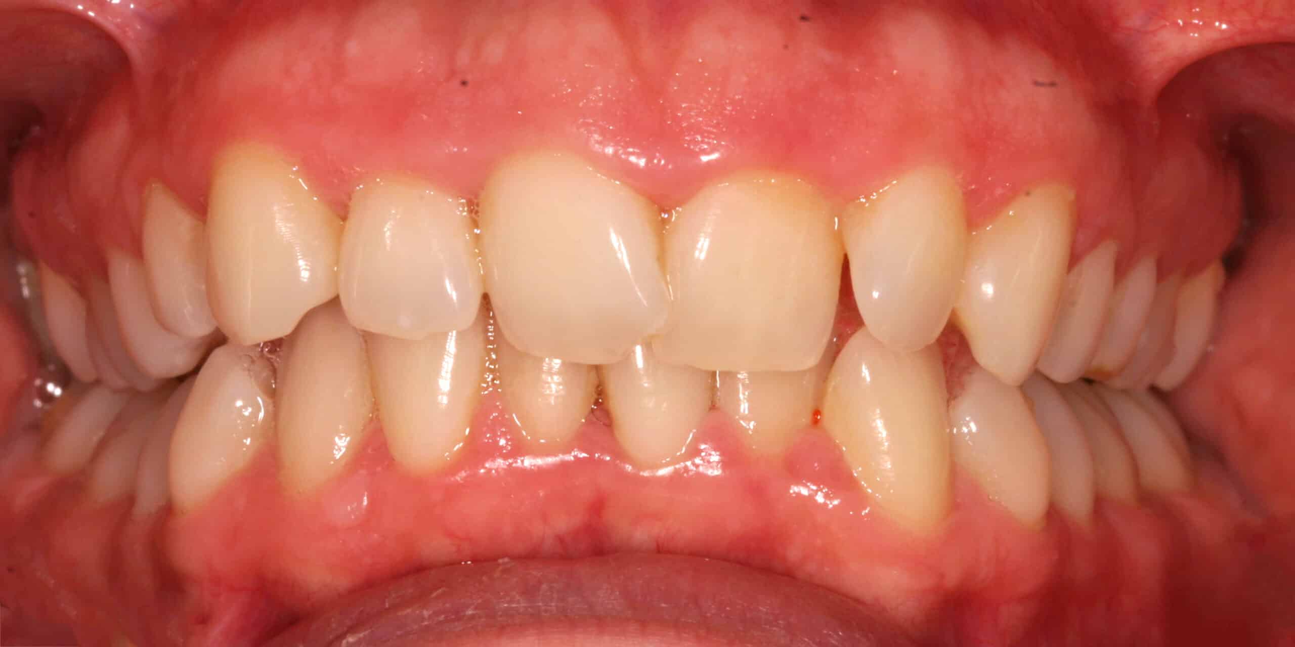 Invisalign® Treatment | Sandygate Dental