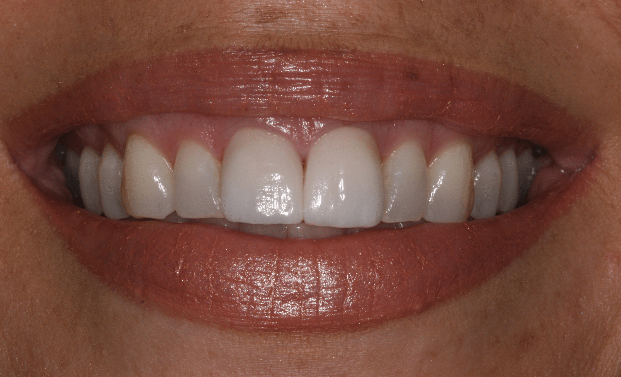 Crowns | Sandygate Dental