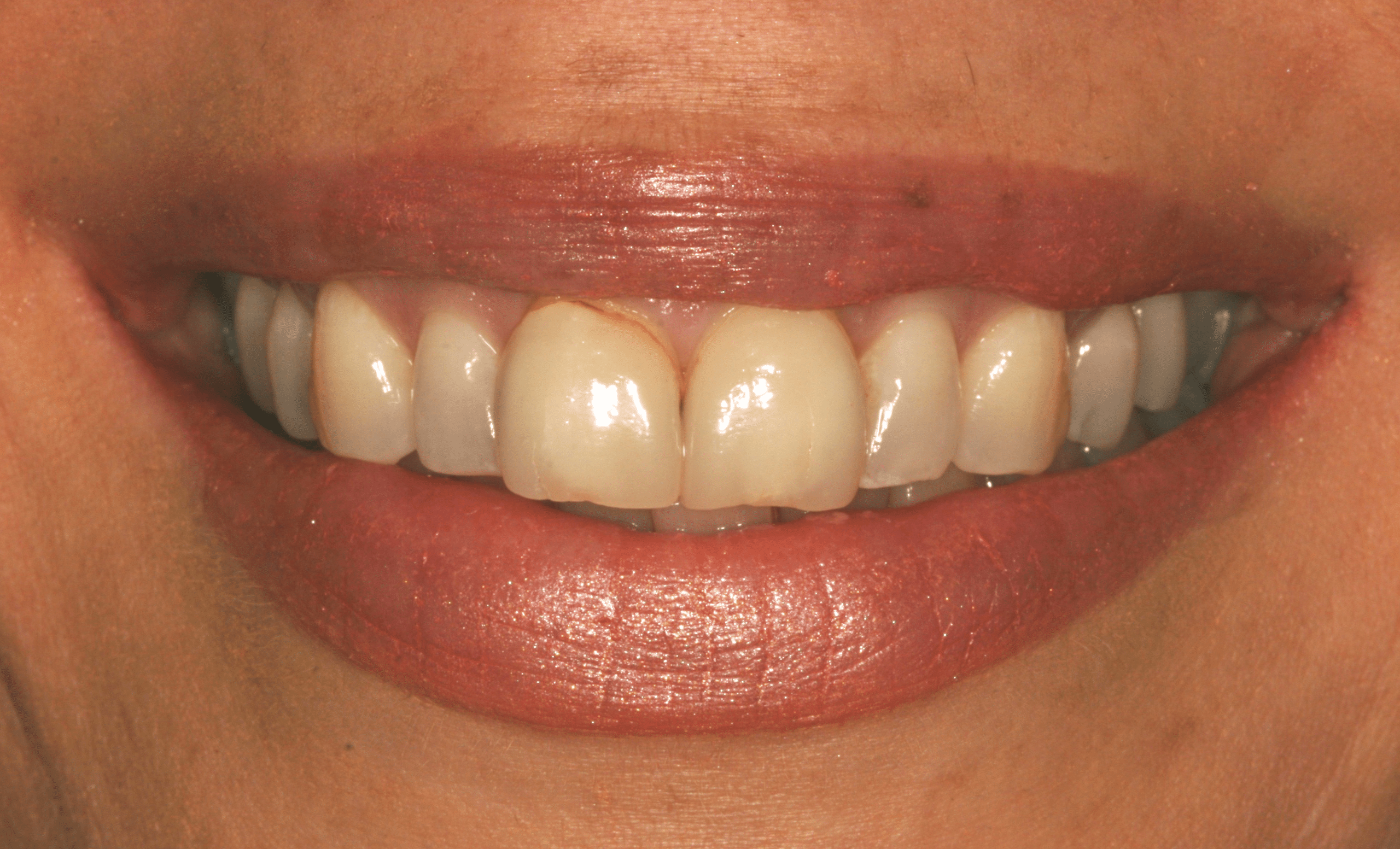 Crowns | Sandygate Dental